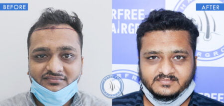 front view of before and after teenage hair loss male treatment done at best hair transplant clinic in india hairfree and hairgrow clinic