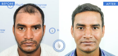 front view of before and after male baldness treatment done at best hair transplant clinic in india hairfree and hairgrow clinic