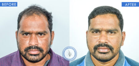 front view of before and after beginning male pattern baldness treatment done at best hair transplant clinic in india hairfree and hairgrow clinic