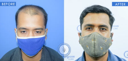 front view of before and after mens hair surgery treatment done at best hair transplant clinic in india hairfree and hairgrow clinic