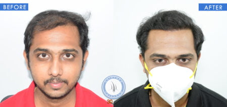 front view of before and after male hair surgery treatment done at best hair transplant clinic in india hairfree and hairgrow clinic