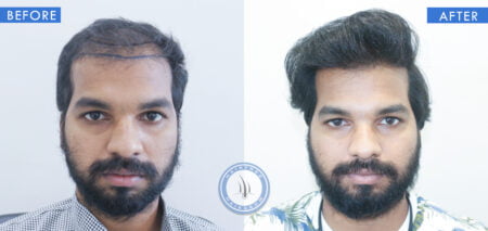 front view of before and after hair replacement surgery for men treatment done at best hair transplant clinic in india hairfree and hairgrow clinic