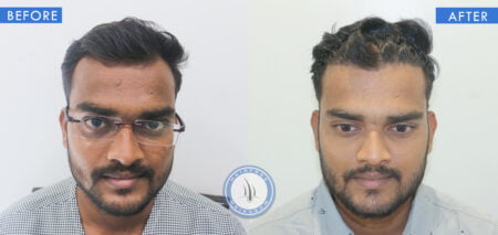 front view of before and after hair loss treatment for men done at best hair transplant clinic in india hairfree and hairgrow clinic