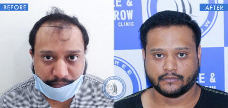 front view of before and after hair transplant results for treatment done at best hair transplant clinic in india hairfree and hairgrow clinic