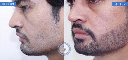 left view of before and after beard hair transplantation done at hairfree and hairgrow clinic