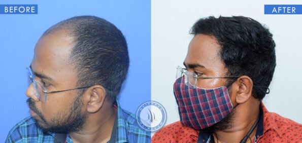 left view of before and after results of alopecia areata treatment done at best hair transplant clinic in india hairfree and hairgrow clinic