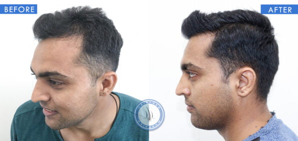 left view of before and after results of hair loss telogen effluvium treatment done at best hair transplant clinic in india hairfree hairgrow