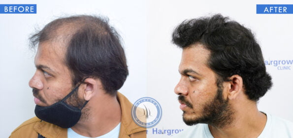 left view of before and after results of alopecia with scarring treatment done at best hair transplant clinic in india hairfree and hairgrow clinic