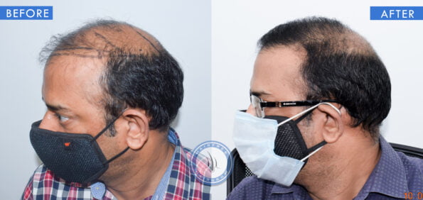 left view of before and after results of patchy baldness treatment done at best hair transplant clinic in india hairfree and hairgrow clinic