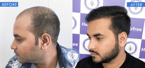 left view of before and after results of hair loss in patches treatment done at best hair transplant clinic in india hairfree and hairgrow clinic