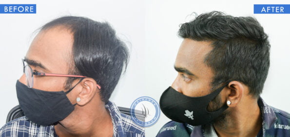 left view of before and after results of hair loss treatment for men done at best hair transplant clinic in india hairfree and hairgrow clinic