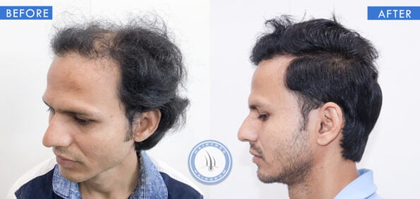 left view of before and after results of hair loss treatment done at best hair transplant clinic in india hairfree and hairgrow clinic