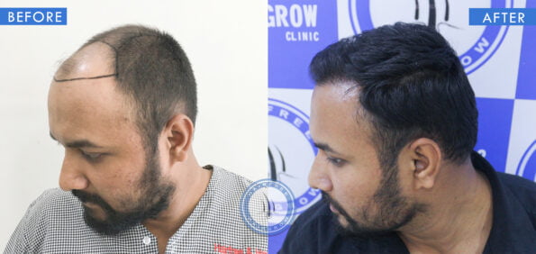 left view of before and after treatment of hair fall in male done at best hair transplant clinic in india hairfree and hairgrow clinic