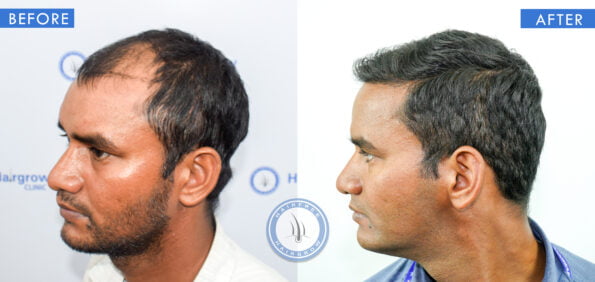 left view of before and after hair loss front of head male treatment done at best hair transplant clinic in india hairfree and hairgrow clinic