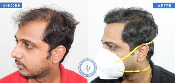 left view of before and after men's hair loss surgery treatment done at best hair transplant clinic in india hairfree and hairgrow clinic