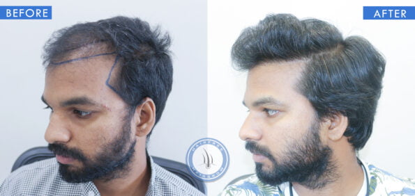 left view of before and after male hair restoration treatment done at best hair transplant clinic in india hairfree and hairgrow clinic