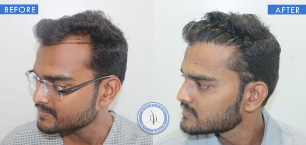 left view of before and after baldness in men treatment done at best hair transplant clinic in india hairfree and hairgrow clinic