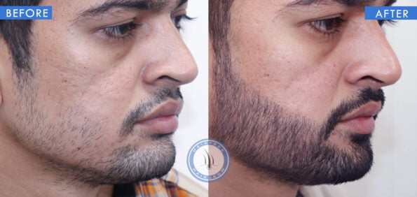 right view of before and after beard hair transplant done at hairfree and hairgrow clinic