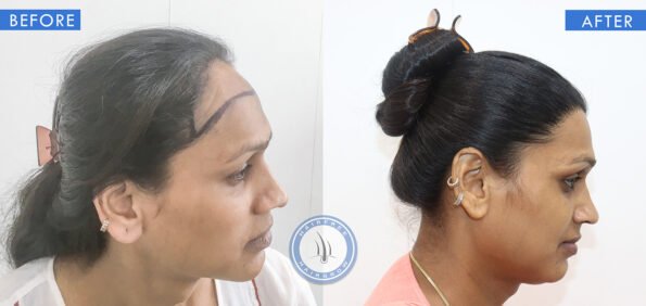 right view of before and after results of female baldness treatment done at best hair transplant clinic in india hairfree and hairgrow clinic