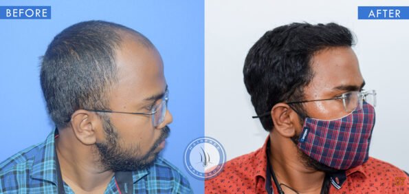 right view of before and after results of male pattern baldness treatment done at best hair transplant clinic in india hairfree and hairgrow