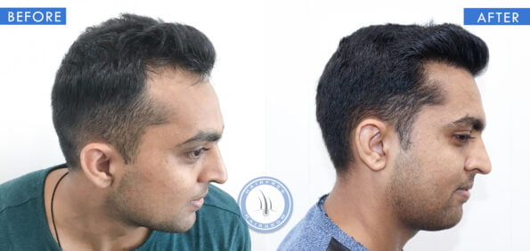 right view of before and after results of follicular unit extraction treatment done at best hair transplant clinic in india hairfree hairgrow