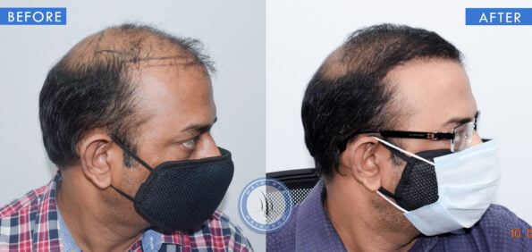 right view of before and after results of micropigmentation of scalp treatment done at best hair transplant clinic in india hairfree and hairgrow clinic