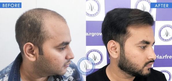 right view of before and after results of best hair fall treatment done at best hair transplant clinic in india hairfree and hairgrow clinic