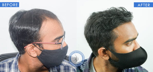 right view of before and after results of friction alopecia treatment done at best hair transplant clinic in india hairfree and hairgrow clinic