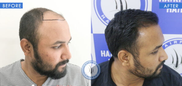 right view of before and after results of hair loss on sides of head male treatment done at best hair transplant clinic in india