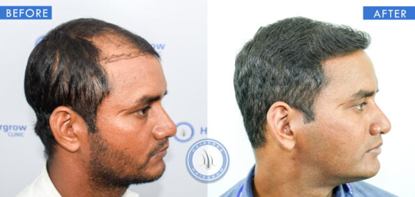 right view of before and after losing hair at 25 male treatment done at best hair transplant clinic in india hairfree and hairgrow clinic