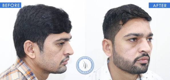 right view of before and after beard hair transplant done at hairfree and hairgrow clinic