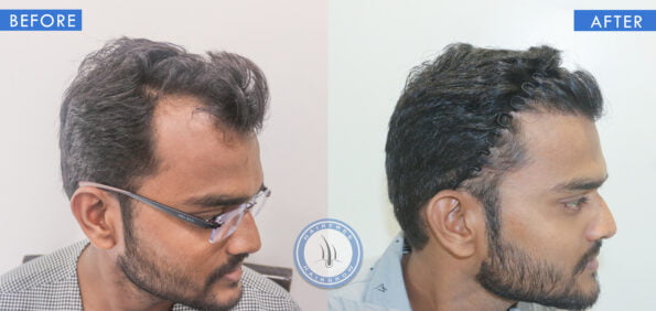 right view of before and after balding men treatment done at best hair transplant clinic in india hairfree and hairgrow clinic