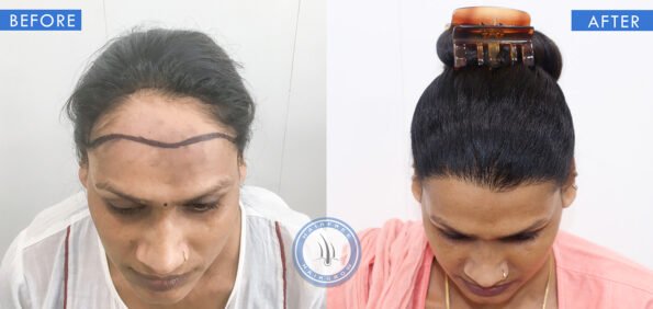 top view of before and after results of alopecia female pattern baldness treatment done at best hair transplant clinic in india hairfree hairgrow