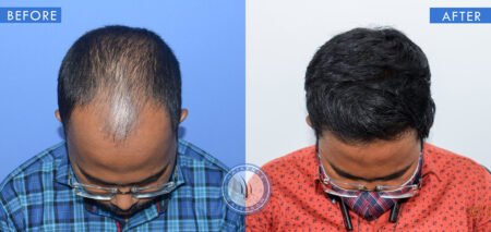 top view of before and after results of frontal hair loss treatment done at best hair transplant clinic in india hairfree and hairgrow clinic