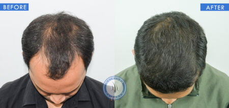 top view of before and after results of baldness treatment done at best hair transplant clinic in india hairfree and hairgrow clinic