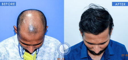 top view of before and after results of male pattern baldness treatments done at best hair transplant clinic in india hairfree and hairgrow