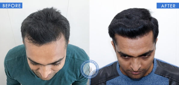 top view of before and after results of baldness in men treatment done at best hair transplant clinic in india hairfree and hairgrow clinic