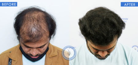 top view of before and after results of scalp micropigmentation treatment done at best hair transplant clinic in india hairfree and hairgrow clinic