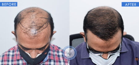 top view of before and after results of infected hair follicle treatment done at best hair transplant clinic in india hairfree and hairgrow