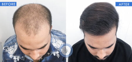 top view of before and after results of bald hair man treatment done at best hair transplant clinic in india hairfree and hairgrow clinic