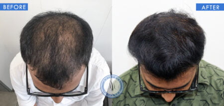 top view of before and after results of scalp micro pigmentation treatment done at best hair transplant clinic in india hairfree hairgrow