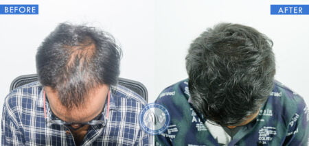 top view of before and after results of bald hair treatment done at best hair transplant clinic in india hairfree and hairgrow clinic