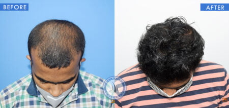 top view of before and after results of meso treatment done at best hair transplant clinic in india hairfree and hairgrow clinic