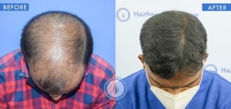 top view of before and after results of alopecia treatment done at best hair transplant clinic in india hairfree and hairgrow clinic