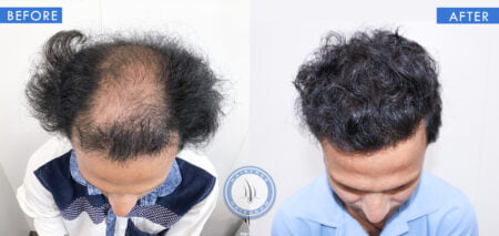 top view of before and after results of alopecia areata treatment done at best hair transplant clinic in india hairfree and hairgrow clinic