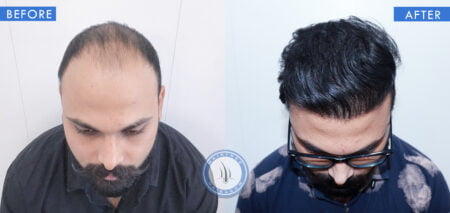 top view of before and after results of androgenetic baldness treatment done at best hair transplant clinic in india hairfree and hairgrow