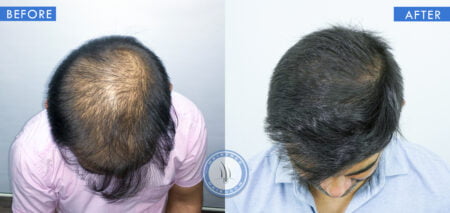 top view of before and after results of hair transplant treatment done at best hair transplant clinic in india hairfree and hairgrow clinic