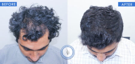 top view of before and after results of male hair loss treatment done at best hair transplant clinic in india hairfree and hairgrow clinic