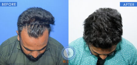 top view of before and after results of front hair loss male treatment done at best hair transplant clinic in india hairfree and hairgrow clinic