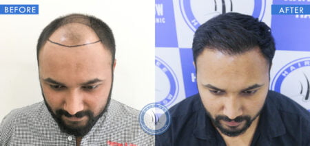 top view of before and after telogen effluvium in male treatment done at best hair transplant clinic in india hairfree and hairgrow clinic